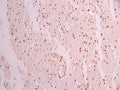 IHC image of CSB-RA163914A0HU diluted at 1:100 and staining in paraffin-embedded human glioma cancer performed on a Leica BondTM system. After dewaxing and hydration, antigen retrieval was mediated by high pressure in a citrate buffer (pH 6.0) . Section was blocked with 10% normal goat serum 30min at RT. Then primary antibody (1% BSA) was incubated at 4°C overnight. The primary is detected by a Goat anti-rabbit polymer IgG labeled by HRP and visualized using 0.05% DAB.