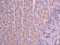 IHC image of CSB-RA168797A0HU diluted at 1:100 and staining in paraffin-embedded human gastric cancer performed on a Leica BondTM system. After dewaxing and hydration, antigen retrieval was mediated by high pressure in a citrate buffer (pH 6.0) . Section was blocked with 10% normal goat serum 30min at RT. Then primary antibody (1% BSA) was incubated at 4°C overnight. The primary is detected by a Goat anti-rabbit polymer IgG labeled by HRP and visualized using 0.05% DAB.