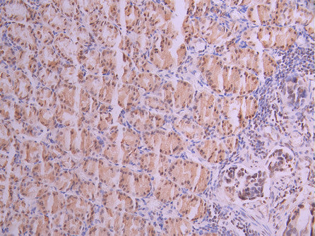 IHC image of CSB-RA168797A0HU diluted at 1:100 and staining in paraffin-embedded human gastric cancer performed on a Leica BondTM system. After dewaxing and hydration, antigen retrieval was mediated by high pressure in a citrate buffer (pH 6.0) . Section was blocked with 10% normal goat serum 30min at RT. Then primary antibody (1% BSA) was incubated at 4°C overnight. The primary is detected by a Goat anti-rabbit polymer IgG labeled by HRP and visualized using 0.05% DAB.