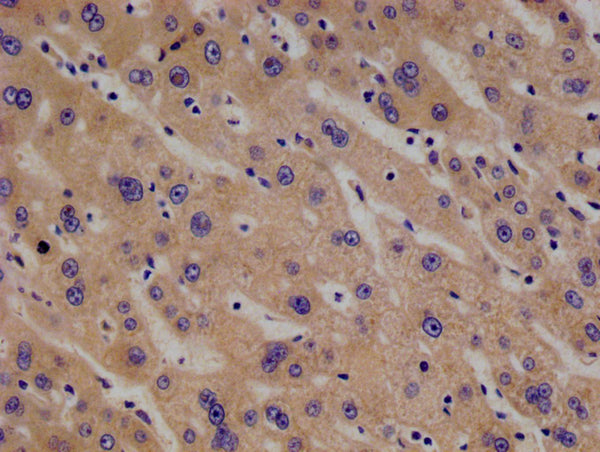 IHC image of CSB-RA169000A0HU diluted at 1:100 and staining in paraffin-embedded human liver cancer performed on a Leica BondTM system. After dewaxing and hydration, antigen retrieval was mediated by high pressure in a citrate buffer (pH 6.0) . Section was blocked with 10% normal goat serum 30min at RT. Then primary antibody (1% BSA) was incubated at 4°C overnight. The primary is detected by a Goat anti-rabbit polymer IgG labeled by HRP and visualized using 0.05% DAB.