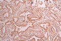 IHC image of CSB-RA171352A0HU diluted at 1:100 and staining in paraffin-embedded human cervical cancer performed on a Leica BondTM system. After dewaxing and hydration, antigen retrieval was mediated by high pressure in a citrate buffer (pH 6.0) . Section was blocked with 10% normal goat serum 30min at RT. Then primary antibody (1% BSA) was incubated at 4°C overnight. The primary is detected by a Goat anti-rabbit polymer IgG labeled by HRP and visualized using 0.05% DAB.