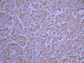 IHC image of CSB-RA181279A0HU diluted at 1:100 and staining in paraffin-embedded human cervical cancer performed on a Leica BondTM system. After dewaxing and hydration, antigen retrieval was mediated by high pressure in a citrate buffer (pH 6.0). Section was blocked with 10% normal goat serum 30min at RT. Then primary antibody (1% BSA) was incubated at 4°C overnight. The primary is detected by a Goat anti-rabbit polymer IgG labeled by HRP and visualized using 0.05% DAB.