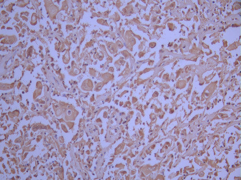IHC image of CSB-RA181279A0HU diluted at 1:100 and staining in paraffin-embedded human cervical cancer performed on a Leica BondTM system. After dewaxing and hydration, antigen retrieval was mediated by high pressure in a citrate buffer (pH 6.0). Section was blocked with 10% normal goat serum 30min at RT. Then primary antibody (1% BSA) was incubated at 4°C overnight. The primary is detected by a Goat anti-rabbit polymer IgG labeled by HRP and visualized using 0.05% DAB.