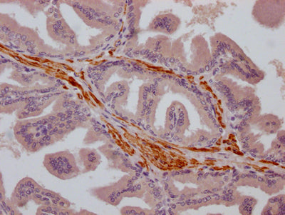 IHC image of CSB-RA186773A0HU diluted at 1:100 and staining in paraffin-embedded human prostate cancer performed on a Leica BondTM system. After dewaxing and hydration, antigen retrieval was mediated by high pressure in a citrate buffer (pH 6.0) . Section was blocked with 10% normal goat serum 30min at RT. Then primary antibody (1% BSA) was incubated at 4℃ overnight. The primary is detected by a Goat anti-rabbit IgG polymer labeled by HRP and visualized using 0.05% DAB.