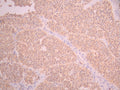 IHC image of CSB-RA188883A0HU diluted at 1:100 and staining in paraffin-embedded human liver cancer performed on a Leica BondTM system. After dewaxing and hydration, antigen retrieval was mediated by high pressure in a citrate buffer (pH 6.0). Section was blocked with 10% normal goat serum 30min at RT. Then primary antibody (1% BSA) was incubated at 4°C overnight. The primary is detected by a Goat anti-rabbit polymer IgG labeled by HRP and visualized using 0.05% DAB.