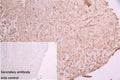 IHC image of CSB-RA191985A0HU diluted at 1:100 and staining in paraffin-embedded human liver cancer performed on a Leica BondTM system. After dewaxing and hydration, antigen retrieval was mediated by high pressure in a citrate buffer (pH 6.0) . Section was blocked with 10% normal goat serum 30min at RT. Then primary antibody (1% BSA) was incubated at 4℃ overnight. The primary is detected by a Goat anti-rabbit IgG polymer labeled by HRP and visualized using 0.05% DAB.