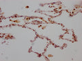 IHC image of CSB-RA198316A0HU diluted at 1:100 and staining in paraffin-embedded human lung tissue performed on a Leica BondTM system. After dewaxing and hydration, antigen retrieval was mediated by high pressure in a citrate buffer (pH 6.0) . Section was blocked with 10% normal goat serum 30min at RT. Then primary antibody (1% BSA) was incubated at 4℃ overnight. The primary is detected by a Goat anti-rabbit IgG polymer labeled by HRP and visualized using 0.05% DAB.