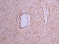 IHC image of CSB-RA198357A0HU diluted at 1:100 and staining in paraffin-embedded human glioma cancer performed on a Leica BondTM system. After dewaxing and hydration, antigen retrieval was mediated by high pressure in a citrate buffer (pH 6.0) . Section was blocked with 10% normal goat serum 30min at RT. Then primary antibody (1% BSA) was incubated at 4°C overnight. The primary is detected by a Goat anti-rabbit polymer IgG labeled by HRP and visualized using 0.05% DAB.