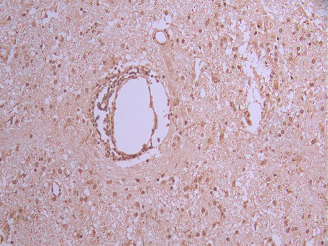 IHC image of CSB-RA198357A0HU diluted at 1:100 and staining in paraffin-embedded human glioma cancer performed on a Leica BondTM system. After dewaxing and hydration, antigen retrieval was mediated by high pressure in a citrate buffer (pH 6.0) . Section was blocked with 10% normal goat serum 30min at RT. Then primary antibody (1% BSA) was incubated at 4°C overnight. The primary is detected by a Goat anti-rabbit polymer IgG labeled by HRP and visualized using 0.05% DAB.