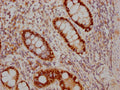 IHC image of CSB-RA202969A0HU diluted at 1:100 and staining in paraffin-embedded human colon cancer performed on a Leica BondTM system. After dewaxing and hydration, antigen retrieval was mediated by high pressure in a citrate buffer (pH 6.0) . Section was blocked with 10% normal goat serum 30min at RT. Then primary antibody (1% BSA) was incubated at 4℃ overnight. The primary is detected by a Goat anti-rabbit IgG polymer labeled by HRP and visualized using 0.05% DAB.