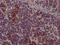 IHC image of CSB-RA206737A0HU diluted at 1:100 and staining in paraffin-embedded human lung cancer performed on a Leica BondTM system. After dewaxing and hydration, antigen retrieval was mediated by high pressure in a citrate buffer (pH 6.0) . Section was blocked with 10% normal goat serum 30min at RT. Then primary antibody (1% BSA) was incubated at 4℃ overnight. The primary is detected by a Goat anti-rabbit IgG polymer labeled by HRP and visualized using 0.05% DAB.