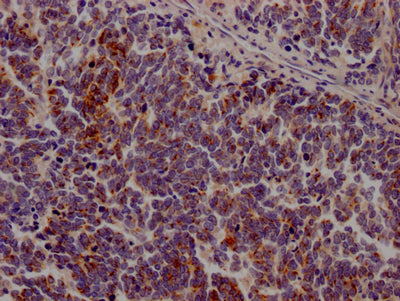 IHC image of CSB-RA206737A0HU diluted at 1:100 and staining in paraffin-embedded human lung cancer performed on a Leica BondTM system. After dewaxing and hydration, antigen retrieval was mediated by high pressure in a citrate buffer (pH 6.0) . Section was blocked with 10% normal goat serum 30min at RT. Then primary antibody (1% BSA) was incubated at 4℃ overnight. The primary is detected by a Goat anti-rabbit IgG polymer labeled by HRP and visualized using 0.05% DAB.