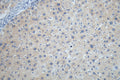 IHC image of CSB-RA207790A0HU diluted at 1:100 and staining in paraffin-embedded human liver cancer performed on a Leica BondTM system. After dewaxing and hydration, antigen retrieval was mediated by high pressure in a citrate buffer (pH 6.0) . Section was blocked with 10% normal goat serum 30min at RT. Then primary antibody (1% BSA) was incubated at 4°C overnight. The primary is detected by a Goat anti-rabbit polymer IgG labeled by HRP and visualized using 0.05% DAB.