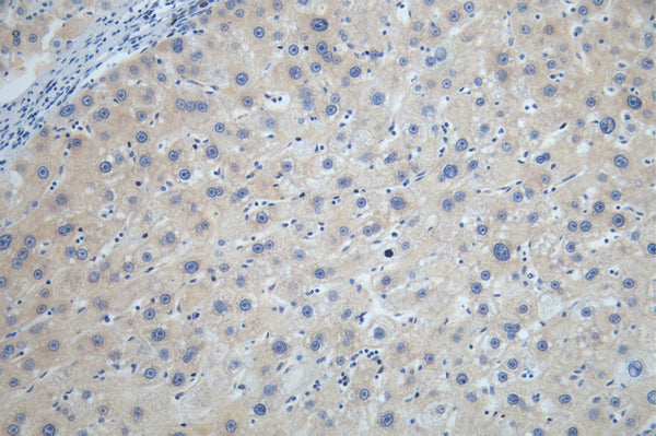 IHC image of CSB-RA207790A0HU diluted at 1:100 and staining in paraffin-embedded human liver cancer performed on a Leica BondTM system. After dewaxing and hydration, antigen retrieval was mediated by high pressure in a citrate buffer (pH 6.0) . Section was blocked with 10% normal goat serum 30min at RT. Then primary antibody (1% BSA) was incubated at 4°C overnight. The primary is detected by a Goat anti-rabbit polymer IgG labeled by HRP and visualized using 0.05% DAB.