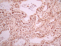 IHC image of CSB-RA208150A0HU diluted at 1:100 and staining in paraffin-embedded human pancreatic cancer performed on a Leica BondTM system. After dewaxing and hydration, antigen retrieval was mediated by high pressure in a citrate buffer (pH 6.0). Section was blocked with 10% normal goat serum 30min at RT. Then primary antibody (1% BSA) was incubated at 4°C overnight. The primary is detected by a Goat anti-rabbit polymer IgG labeled by HRP and visualized using 0.05% DAB.