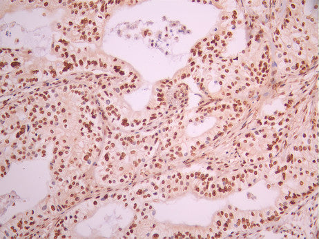 IHC image of CSB-RA208150A0HU diluted at 1:100 and staining in paraffin-embedded human pancreatic cancer performed on a Leica BondTM system. After dewaxing and hydration, antigen retrieval was mediated by high pressure in a citrate buffer (pH 6.0). Section was blocked with 10% normal goat serum 30min at RT. Then primary antibody (1% BSA) was incubated at 4°C overnight. The primary is detected by a Goat anti-rabbit polymer IgG labeled by HRP and visualized using 0.05% DAB.