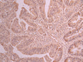 IHC image of CSB-RA209536A0HU diluted at 1:100 and staining in paraffin-embedded human colorectal cancer performed on a Leica BondTM system. After dewaxing and hydration, antigen retrieval was mediated by high pressure in a citrate buffer (pH 6.0) . Section was blocked with 10% normal goat serum 30min at RT. Then primary antibody (1% BSA) was incubated at 4°C overnight. The primary is detected by a Goat anti-rabbit polymer IgG labeled by HRP and visualized using 0.05% DAB.