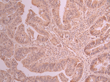 IHC image of CSB-RA209536A0HU diluted at 1:100 and staining in paraffin-embedded human colorectal cancer performed on a Leica BondTM system. After dewaxing and hydration, antigen retrieval was mediated by high pressure in a citrate buffer (pH 6.0) . Section was blocked with 10% normal goat serum 30min at RT. Then primary antibody (1% BSA) was incubated at 4°C overnight. The primary is detected by a Goat anti-rabbit polymer IgG labeled by HRP and visualized using 0.05% DAB.