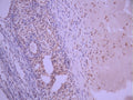IHC image of CSB-RA209742A0HU diluted at 1:100 and staining in paraffin-embedded human ovarian cancer performed on a Leica BondTM system. After dewaxing and hydration, antigen retrieval was mediated by high pressure in a citrate buffer (pH 6.0). Section was blocked with 10% normal goat serum 30min at RT. Then primary antibody (1% BSA) was incubated at 4°C overnight. The primary is detected by a Goat anti-rabbit polymer IgG labeled by HRP and visualized using 0.05% DAB.