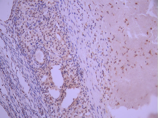 IHC image of CSB-RA209742A0HU diluted at 1:100 and staining in paraffin-embedded human ovarian cancer performed on a Leica BondTM system. After dewaxing and hydration, antigen retrieval was mediated by high pressure in a citrate buffer (pH 6.0). Section was blocked with 10% normal goat serum 30min at RT. Then primary antibody (1% BSA) was incubated at 4°C overnight. The primary is detected by a Goat anti-rabbit polymer IgG labeled by HRP and visualized using 0.05% DAB.