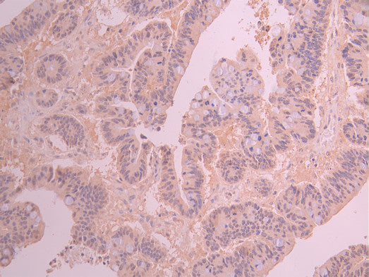 IHC image of CSB-RA213346A0HU diluted at 1:100 and staining in paraffin-embedded human colorectal cancer performed on a Leica BondTM system. After dewaxing and hydration, antigen retrieval was mediated by high pressure in a citrate buffer (pH 6.0) . Section was blocked with 10% normal goat serum 30min at RT. Then primary antibody (1% BSA) was incubated at 4°C overnight. The primary is detected by a Goat anti-rabbit polymer IgG labeled by HRP and visualized using 0.05% DAB.