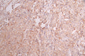 IHC image of CSB-RA215300A0HU diluted at 1:100 and staining in paraffin-embedded human breast cancer performed on a Leica BondTM system. After dewaxing and hydration, antigen retrieval was mediated by high pressure in a citrate buffer (pH 6.0) . Section was blocked with 10% normal goat serum 30min at RT. Then primary antibody (1% BSA) was incubated at 4°C overnight. The primary is detected by a Goat anti-rabbit polymer IgG labeled by HRP and visualized using 0.05% DAB.