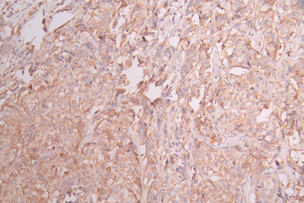 IHC image of CSB-RA215300A0HU diluted at 1:100 and staining in paraffin-embedded human breast cancer performed on a Leica BondTM system. After dewaxing and hydration, antigen retrieval was mediated by high pressure in a citrate buffer (pH 6.0) . Section was blocked with 10% normal goat serum 30min at RT. Then primary antibody (1% BSA) was incubated at 4°C overnight. The primary is detected by a Goat anti-rabbit polymer IgG labeled by HRP and visualized using 0.05% DAB.