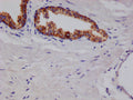 IHC image of CSB-RA216908A0HU diluted at 1:100 and staining in paraffin-embedded human prostate cancer performed on a Leica BondTM system. After dewaxing and hydration, antigen retrieval was mediated by high pressure in a citrate buffer (pH 6.0) . Section was blocked with 10% normal goat serum 30min at RT. Then primary antibody (1% BSA) was incubated at 4°C overnight. The primary is detected by a Goat anti-rabbit polymer IgG labeled by HRP and visualized using 0.05% DAB.