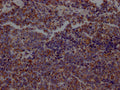 IHC image of CSB-RA218127A0HU diluted at 1:100 and staining in paraffin-embedded human lung cancer performed on a Leica BondTM system. After dewaxing and hydration, antigen retrieval was mediated by high pressure in a citrate buffer (pH 6.0) . Section was blocked with 10% normal goat serum 30min at RT. Then primary antibody (1% BSA) was incubated at 4℃ overnight. The primary is detected by a Goat anti-rabbit IgG polymer labeled by HRP and visualized using 0.05% DAB.
