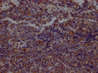 IHC image of CSB-RA218127A0HU diluted at 1:100 and staining in paraffin-embedded human lung cancer performed on a Leica BondTM system. After dewaxing and hydration, antigen retrieval was mediated by high pressure in a citrate buffer (pH 6.0) . Section was blocked with 10% normal goat serum 30min at RT. Then primary antibody (1% BSA) was incubated at 4℃ overnight. The primary is detected by a Goat anti-rabbit IgG polymer labeled by HRP and visualized using 0.05% DAB.
