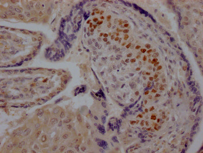 IHC image of CSB-RA224072A0HU diluted at 1:100 and staining in paraffin-embedded human placenta tissue performed on a Leica BondTM system. After dewaxing and hydration, antigen retrieval was mediated by high pressure in a citrate buffer (pH 6.0) . Section was blocked with 10% normal goat serum 30min at RT. Then primary antibody (1% BSA) was incubated at 4℃ overnight. The primary is detected by a Goat anti-rabbit IgG polymer labeled by HRP and visualized using 0.05% DAB.
