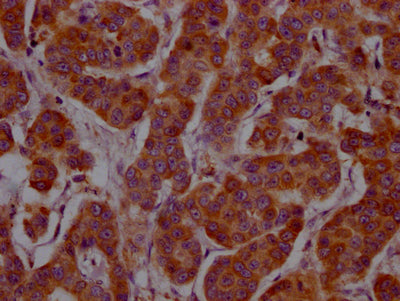 IHC image of CSB-RA240377A0HU diluted at 1:100 and staining in paraffin-embedded human breast cancer performed on a Leica BondTM system. After dewaxing and hydration, antigen retrieval was mediated by high pressure in a citrate buffer (pH 6.0) . Section was blocked with 10% normal goat serum 30min at RT. Then primary antibody (1% BSA) was incubated at 4℃ overnight. The primary is detected by a Goat anti-rabbit IgG polymer labeled by HRP and visualized using 0.05% DAB.