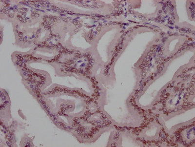 IHC image of CSB-RA243116A0HU diluted at 1:100 and staining in paraffin-embedded human prostate tissue performed on a Leica BondTM system. After dewaxing and hydration, antigen retrieval was mediated by high pressure in a citrate buffer (pH 6.0) . Section was blocked with 10% normal goat serum 30min at RT. Then primary antibody (1% BSA) was incubated at 4℃ overnight. The primary is detected by a Goat anti-rabbit IgG polymer labeled by HRP and visualized using 0.05% DAB.