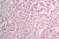 IHC image of CSB-RA244970A0HU diluted at 1:100 and staining in paraffin-embedded human breast cancer performed on a Leica BondTM system. After dewaxing and hydration, antigen retrieval was mediated by high pressure in a citrate buffer (pH 6.0) . Section was blocked with 10% normal goat serum 30min at RT. Then primary antibody (1% BSA) was incubated at 4°C overnight. The primary is detected by a Goat anti-rabbit polymer IgG labeled by HRP and visualized using 0.05% DAB.
