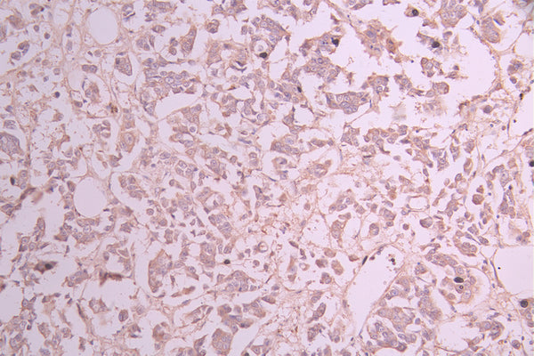 IHC image of CSB-RA244970A0HU diluted at 1:100 and staining in paraffin-embedded human breast cancer performed on a Leica BondTM system. After dewaxing and hydration, antigen retrieval was mediated by high pressure in a citrate buffer (pH 6.0) . Section was blocked with 10% normal goat serum 30min at RT. Then primary antibody (1% BSA) was incubated at 4°C overnight. The primary is detected by a Goat anti-rabbit polymer IgG labeled by HRP and visualized using 0.05% DAB.