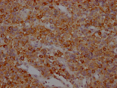 IHC image of CSB-RA246354A0HU diluted at 1:100 and staining in paraffin-embedded human glioma cancer performed on a Leica BondTM system. After dewaxing and hydration, antigen retrieval was mediated by high pressure in a citrate buffer (pH 6.0) . Section was blocked with 10% normal goat serum 30min at RT. Then primary antibody (1% BSA) was incubated at 4℃ overnight. The primary is detected by a Goat anti-rabbit IgG polymer labeled by HRP and visualized using 0.05% DAB.