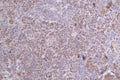 IHC image of CSB-RA24801:50A0HU diluted at 1:100 and staining in paraffin-embedded human ovarian cancer performed on a Leica BondTM system. After dewaxing and hydration, antigen retrieval was mediated by high pressure in a citrate buffer (pH 6.0) . Section was blocked with 10% normal goat serum 30min at RT. Then primary antibody (1% BSA) was incubated at 4°C overnight. The primary is detected by a Goat anti-rabbit polymer IgG labeled by HRP and visualized using 0.59% DAB.