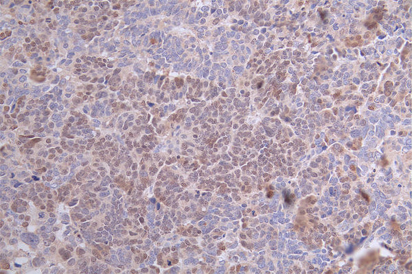 IHC image of CSB-RA24801:50A0HU diluted at 1:100 and staining in paraffin-embedded human ovarian cancer performed on a Leica BondTM system. After dewaxing and hydration, antigen retrieval was mediated by high pressure in a citrate buffer (pH 6.0) . Section was blocked with 10% normal goat serum 30min at RT. Then primary antibody (1% BSA) was incubated at 4°C overnight. The primary is detected by a Goat anti-rabbit polymer IgG labeled by HRP and visualized using 0.59% DAB.