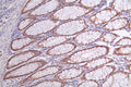 IHC image of CSB-RA249987A0HU diluted at 1:50 and staining in paraffin-embedded human rectal cancer performed on a Leica BondTM system. After dewaxing and hydration, antigen retrieval was mediated by high pressure in a citrate buffer (pH 6.0) . Section was blocked with 10% normal goat serum 30min at RT. Then primary antibody (1% BSA) was incubated at 4°C overnight. The primary is detected by a Goat anti-rabbit polymer IgG labeled by HRP and visualized using 0.68% DAB.