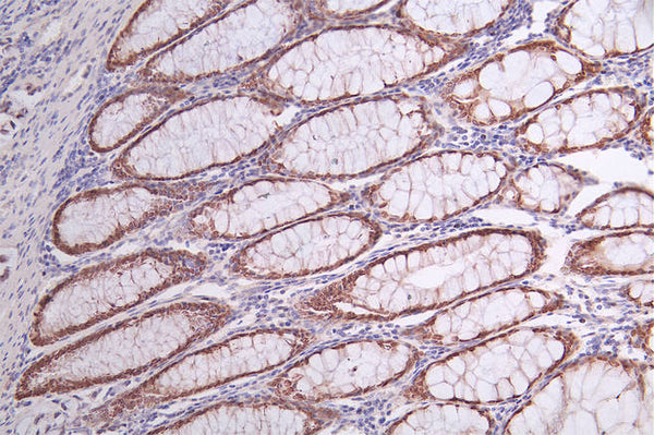 IHC image of CSB-RA249987A0HU diluted at 1:50 and staining in paraffin-embedded human rectal cancer performed on a Leica BondTM system. After dewaxing and hydration, antigen retrieval was mediated by high pressure in a citrate buffer (pH 6.0) . Section was blocked with 10% normal goat serum 30min at RT. Then primary antibody (1% BSA) was incubated at 4°C overnight. The primary is detected by a Goat anti-rabbit polymer IgG labeled by HRP and visualized using 0.68% DAB.