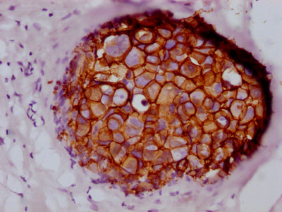 IHC image of CSB-RA260392A0HU diluted at 1:100 and staining in paraffin-embedded human breast cancer performed on a Leica BondTM system. After dewaxing and hydration, antigen retrieval was mediated by high pressure in a citrate buffer (pH 6.0) . Section was blocked with 10% normal goat serum 30min at RT. Then primary antibody (1% BSA) was incubated at 4℃ overnight. The primary is detected by a Goat anti-rabbit IgG polymer labeled by HRP and visualized using 0.05% DAB.