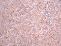 IHC image of CSB-RA262791A0HU diluted at 1:100 and staining in paraffin-embedded human liver cancer performed on a Leica BondTM system. After dewaxing and hydration, antigen retrieval was mediated by high pressure in a citrate buffer (pH 6.0) . Section was blocked with 10% normal goat serum 30min at RT. Then primary antibody (1% BSA) was incubated at 4°C overnight. The primary is detected by a Goat anti-rabbit polymer IgG labeled by HRP and visualized using 0.05% DAB.