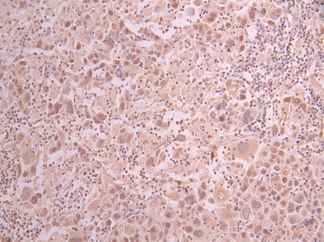 IHC image of CSB-RA262791A0HU diluted at 1:100 and staining in paraffin-embedded human liver cancer performed on a Leica BondTM system. After dewaxing and hydration, antigen retrieval was mediated by high pressure in a citrate buffer (pH 6.0) . Section was blocked with 10% normal goat serum 30min at RT. Then primary antibody (1% BSA) was incubated at 4°C overnight. The primary is detected by a Goat anti-rabbit polymer IgG labeled by HRP and visualized using 0.05% DAB.
