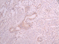 IHC image of CSB-RA268308A0HU diluted at 1:100 and staining in paraffin-embedded human cervical cancer performed on a Leica BondTM system. After dewaxing and hydration, antigen retrieval was mediated by high pressure in a citrate buffer (pH 6.0) . Section was blocked with 10% normal goat serum 30min at RT. Then primary antibody (1% BSA) was incubated at 4°C overnight. The primary is detected by a Goat anti-rabbit polymer IgG labeled by HRP and visualized using 0.05% DAB.