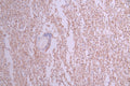 IHC image of CSB-RA268828A0HU diluted at 1:100 and staining in paraffin-embedded human glioma cancer performed on a Leica BondTM system. After dewaxing and hydration, antigen retrieval was mediated by high pressure in a citrate buffer (pH 6.0) . Section was blocked with 10% normal goat serum 30min at RT. Then primary antibody (1% BSA) was incubated at 4°C overnight. The primary is detected by a Goat anti-rabbit polymer IgG labeled by HRP and visualized using 0.05% DAB.