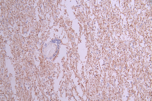 IHC image of CSB-RA268828A0HU diluted at 1:100 and staining in paraffin-embedded human glioma cancer performed on a Leica BondTM system. After dewaxing and hydration, antigen retrieval was mediated by high pressure in a citrate buffer (pH 6.0) . Section was blocked with 10% normal goat serum 30min at RT. Then primary antibody (1% BSA) was incubated at 4°C overnight. The primary is detected by a Goat anti-rabbit polymer IgG labeled by HRP and visualized using 0.05% DAB.