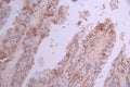 IHC image of CSB-RA276081A0HU diluted at 1:100 and staining in paraffin-embedded human colorectal cancer performed on a Leica BondTM system. After dewaxing and hydration, antigen retrieval was mediated by high pressure in a citrate buffer (pH 6.0) . Section was blocked with 10% normal goat serum 30min at RT. Then primary antibody (1% BSA) was incubated at 4°C overnight. The primary is detected by a Goat anti-rabbit polymer IgG labeled by HRP and visualized using 0.05% DAB.
