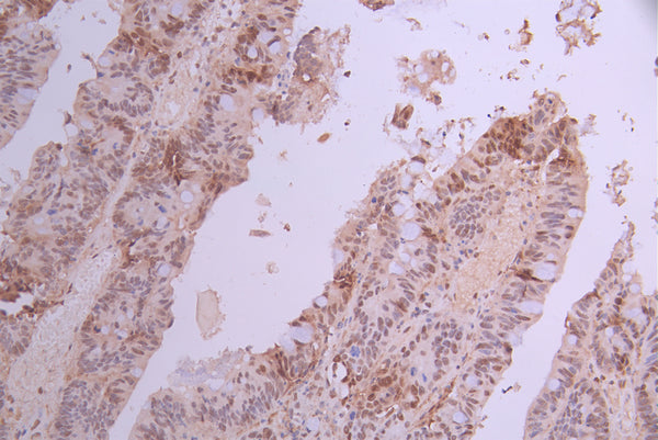 IHC image of CSB-RA276081A0HU diluted at 1:100 and staining in paraffin-embedded human colorectal cancer performed on a Leica BondTM system. After dewaxing and hydration, antigen retrieval was mediated by high pressure in a citrate buffer (pH 6.0) . Section was blocked with 10% normal goat serum 30min at RT. Then primary antibody (1% BSA) was incubated at 4°C overnight. The primary is detected by a Goat anti-rabbit polymer IgG labeled by HRP and visualized using 0.05% DAB.