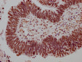IHC image of CSB-RA279005A0HU diluted at 1:100 and staining in paraffin-embedded human ovarian cancer performed on a Leica BondTM system. After dewaxing and hydration, antigen retrieval was mediated by high pressure in a citrate buffer (pH 6.0) . Section was blocked with 10% normal goat serum 30min at RT. Then primary antibody (1% BSA) was incubated at 4℃ overnight. The primary is detected by a Goat anti-rabbit IgG polymer labeled by HRP and visualized using 0.05% DAB.