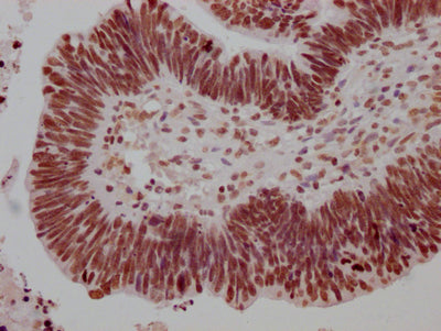 IHC image of CSB-RA279005A0HU diluted at 1:100 and staining in paraffin-embedded human ovarian cancer performed on a Leica BondTM system. After dewaxing and hydration, antigen retrieval was mediated by high pressure in a citrate buffer (pH 6.0) . Section was blocked with 10% normal goat serum 30min at RT. Then primary antibody (1% BSA) was incubated at 4℃ overnight. The primary is detected by a Goat anti-rabbit IgG polymer labeled by HRP and visualized using 0.05% DAB.